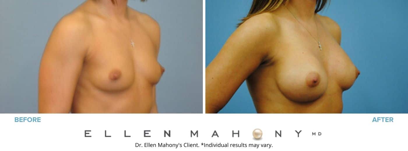 Breast Augmentation | Westport CT | Dr. Ellen Mahony