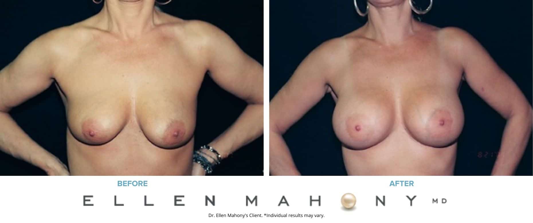 Breast Augmentation | Westport CT | Dr. Ellen Mahony