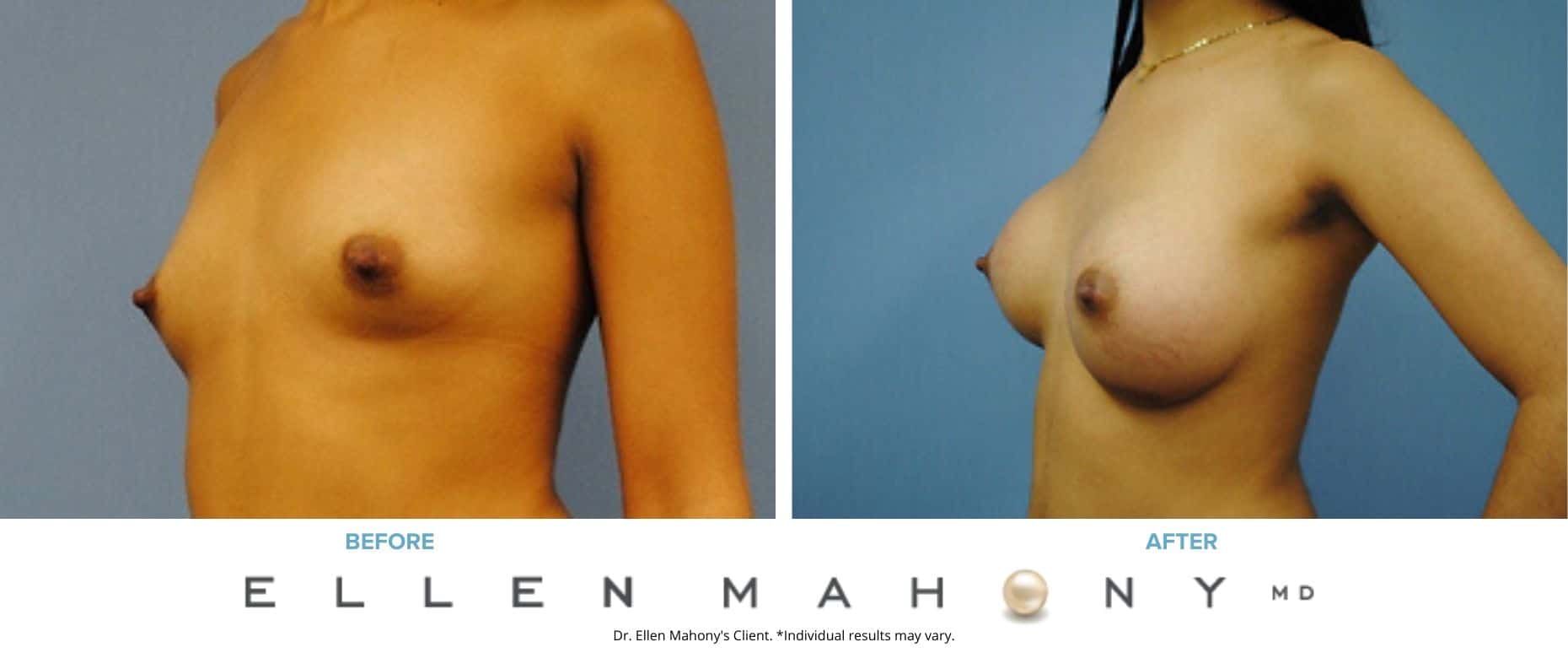 Breast Augmentation | Westport CT | Dr. Ellen Mahony