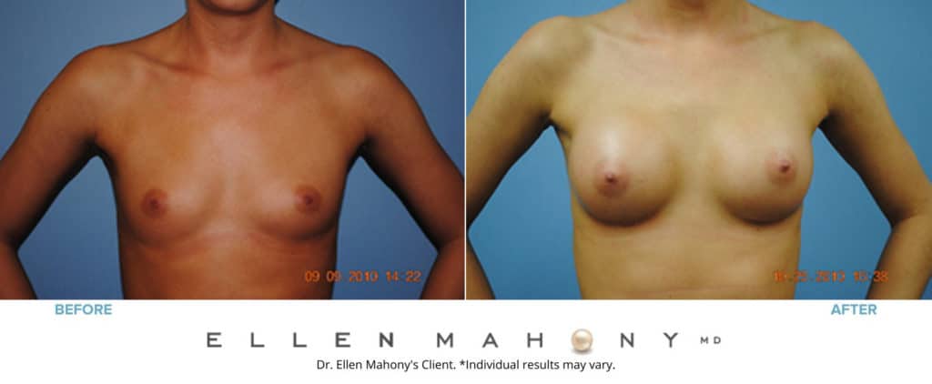 Breast Augmentation | Westport CT | Dr. Ellen Mahony