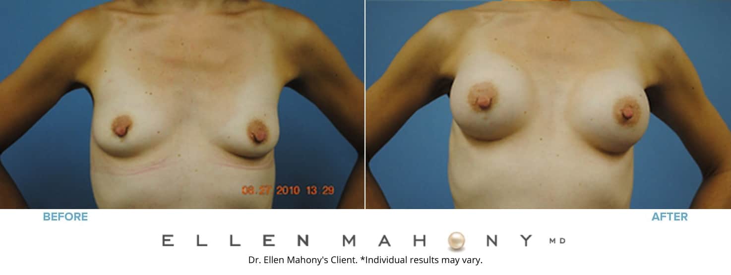 Breast Augmentation | Westport CT | Dr. Ellen Mahony