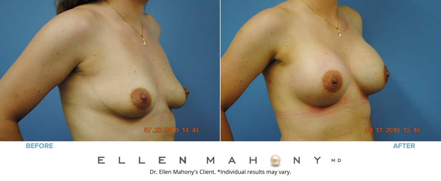 Breast Augmentation | Westport CT | Dr. Ellen Mahony