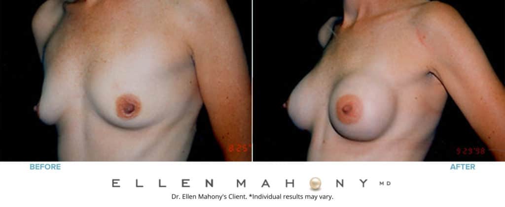 Breast Augmentation | Westport CT | Dr. Ellen Mahony