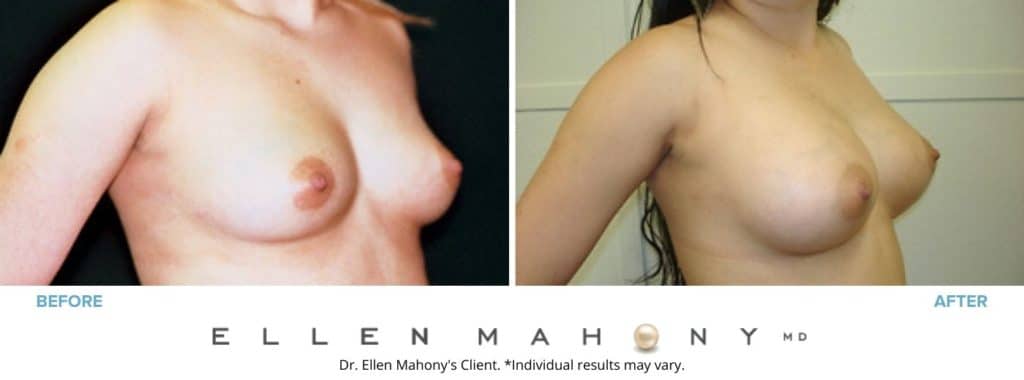 Breast Augmentation | Westport CT | Dr. Ellen Mahony