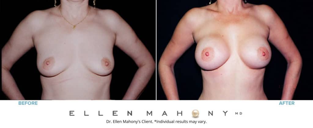 Breast Augmentation | Westport CT | Dr. Ellen Mahony