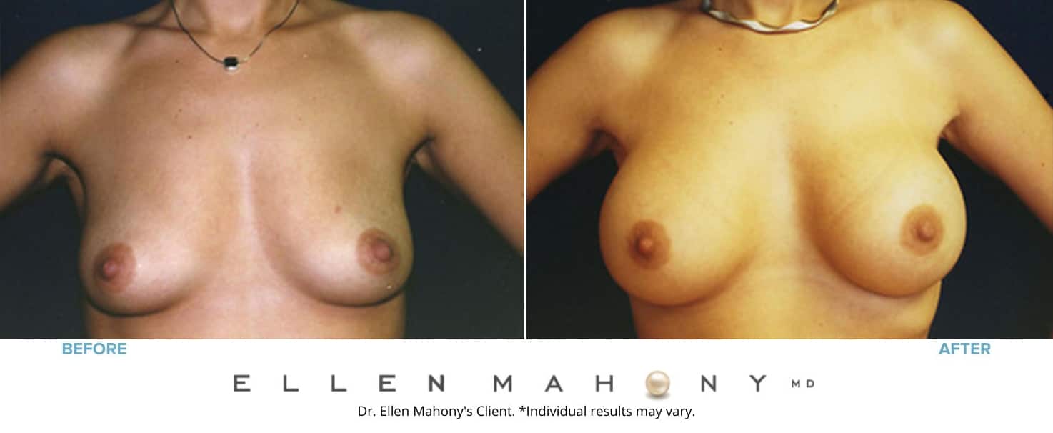 Breast Augmentation | Westport CT | Dr. Ellen Mahony