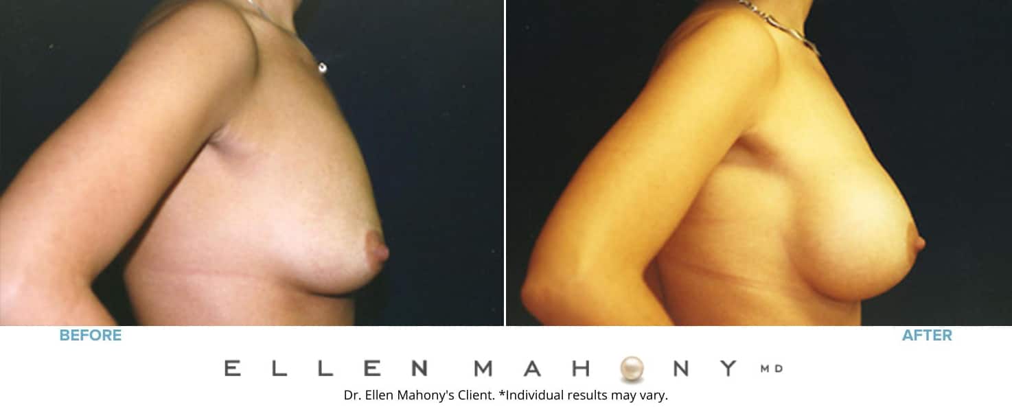 Breast Augmentation | Westport CT | Dr. Ellen Mahony