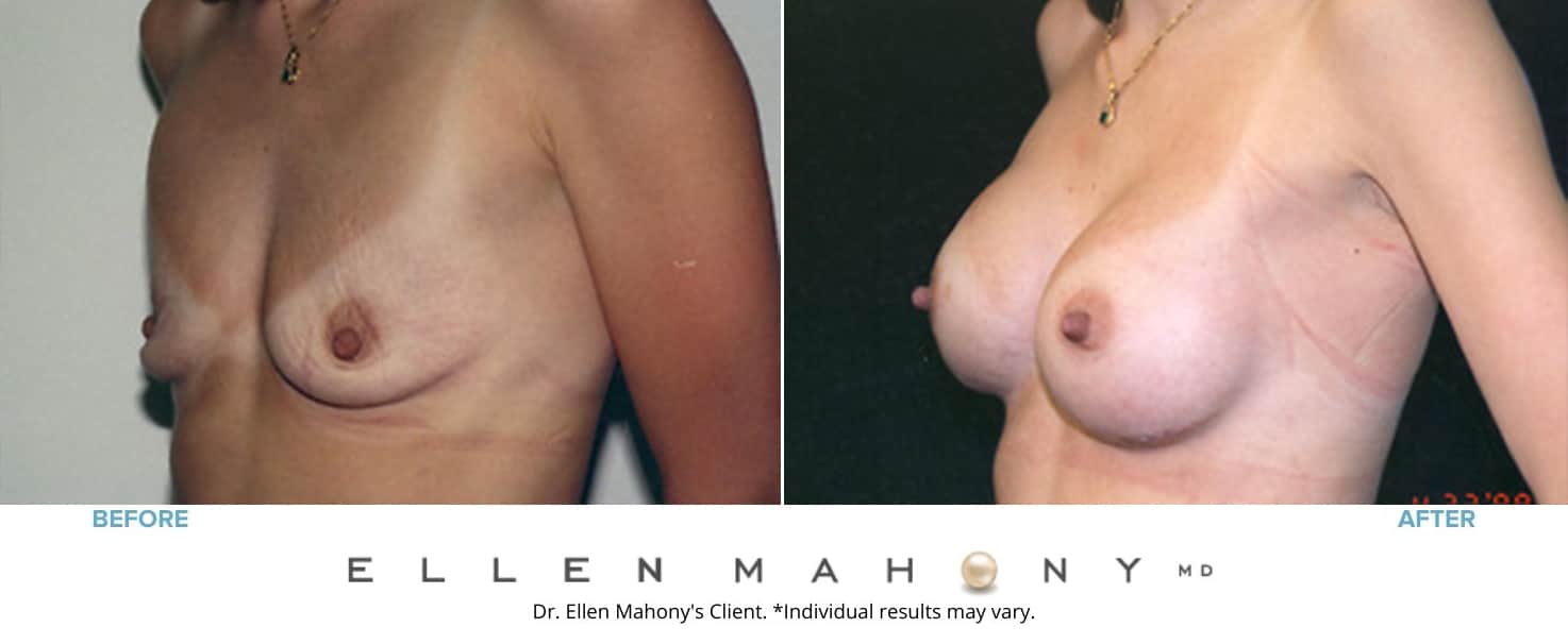 Breast Augmentation | Westport CT | Dr. Ellen Mahony