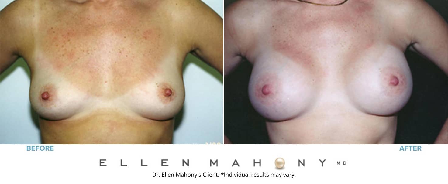 Breast Augmentation | Westport CT | Dr. Ellen Mahony