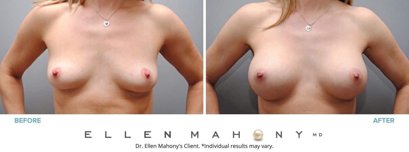 Breast Augmentation | Westport CT | Dr. Ellen Mahony