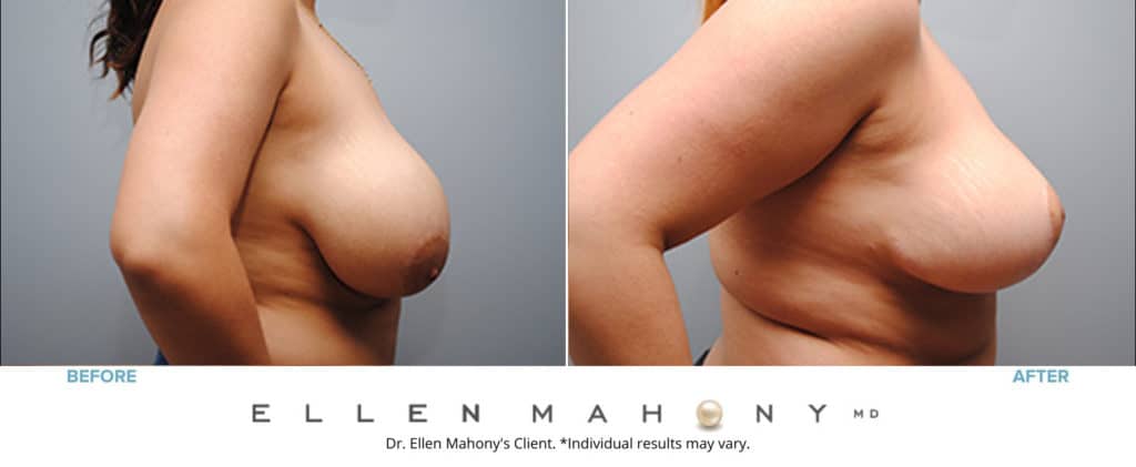 Breast Reduction | Westport CT | Dr. Ellen Mahony