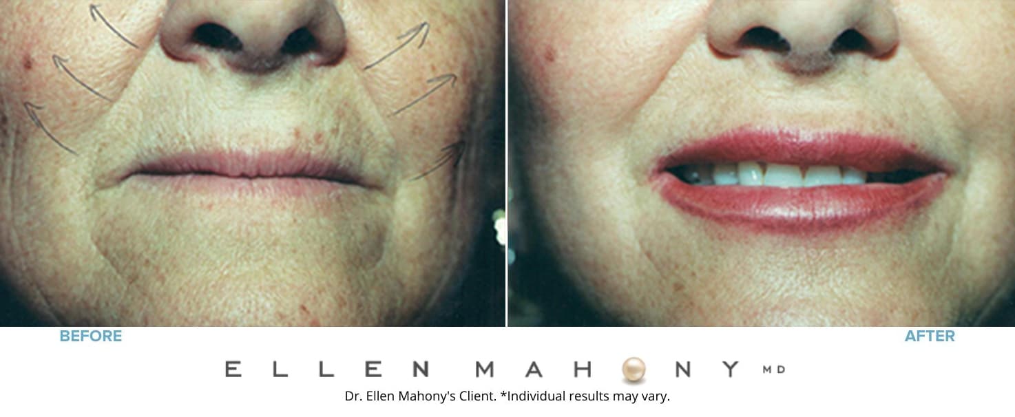 Lip Augmentation | Westport CT | Dr. Ellen Mahony