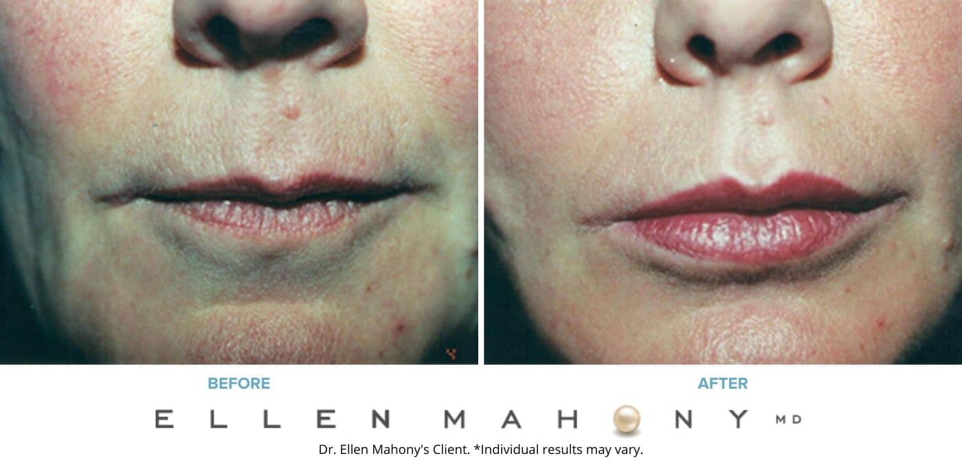 Lip Augmentation | Westport CT | Dr. Ellen Mahony