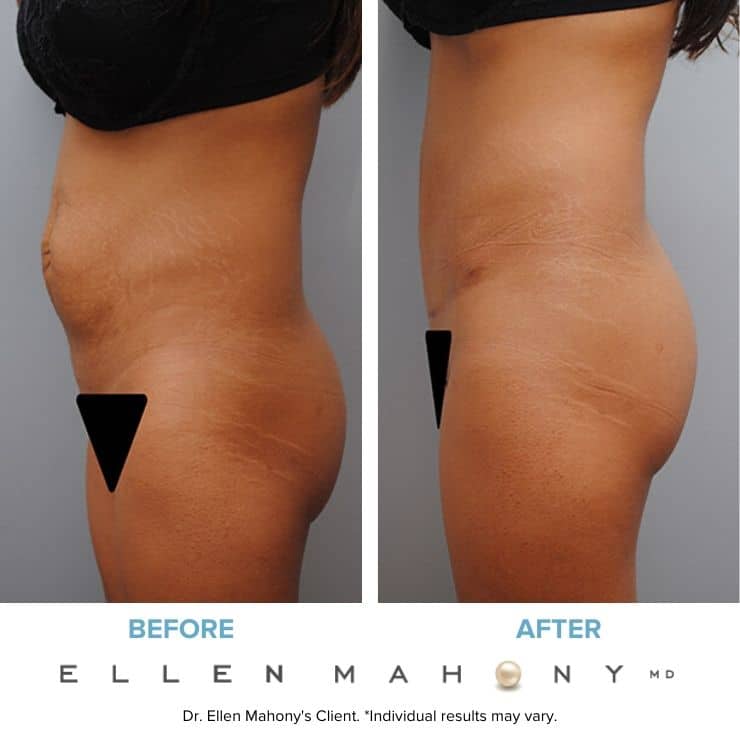 Tummy Tuck with Vertical Scar | Westport CT | Dr. Ellen Mahony