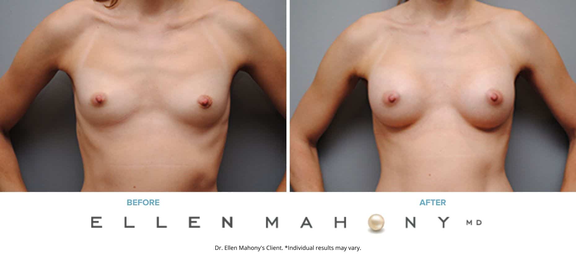 Breast Augmentation | Westport CT | Dr. Ellen Mahony