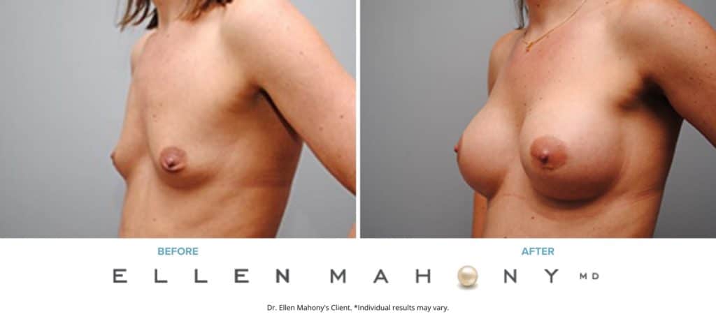 Breast Augmentation | Westport CT | Dr. Ellen Mahony