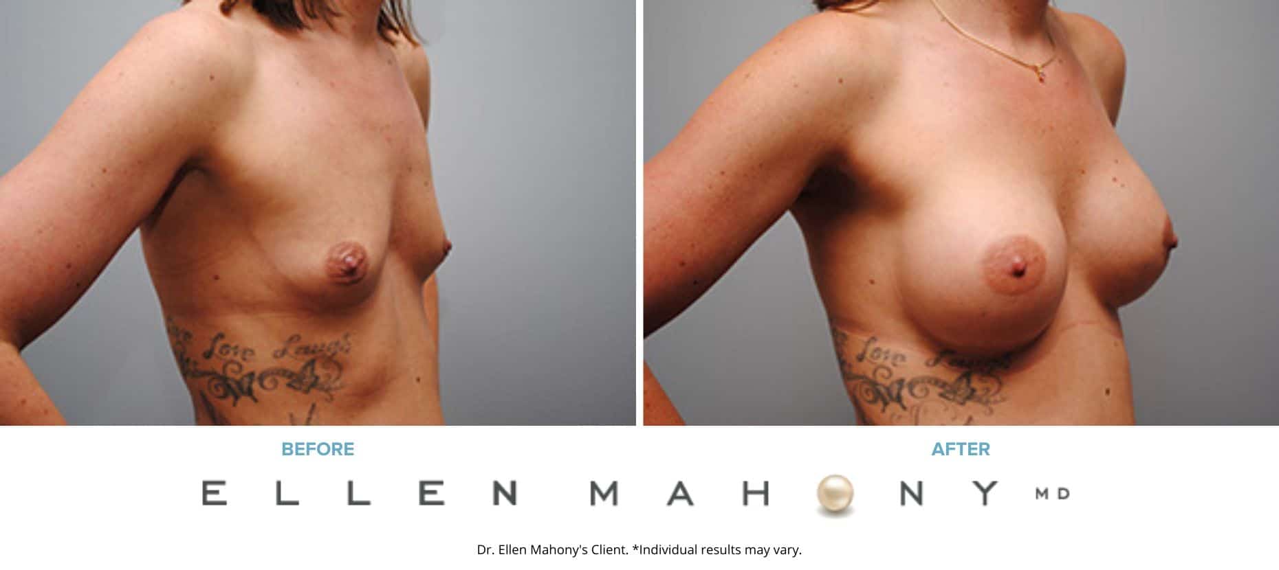 Breast Augmentation | Westport CT | Dr. Ellen Mahony