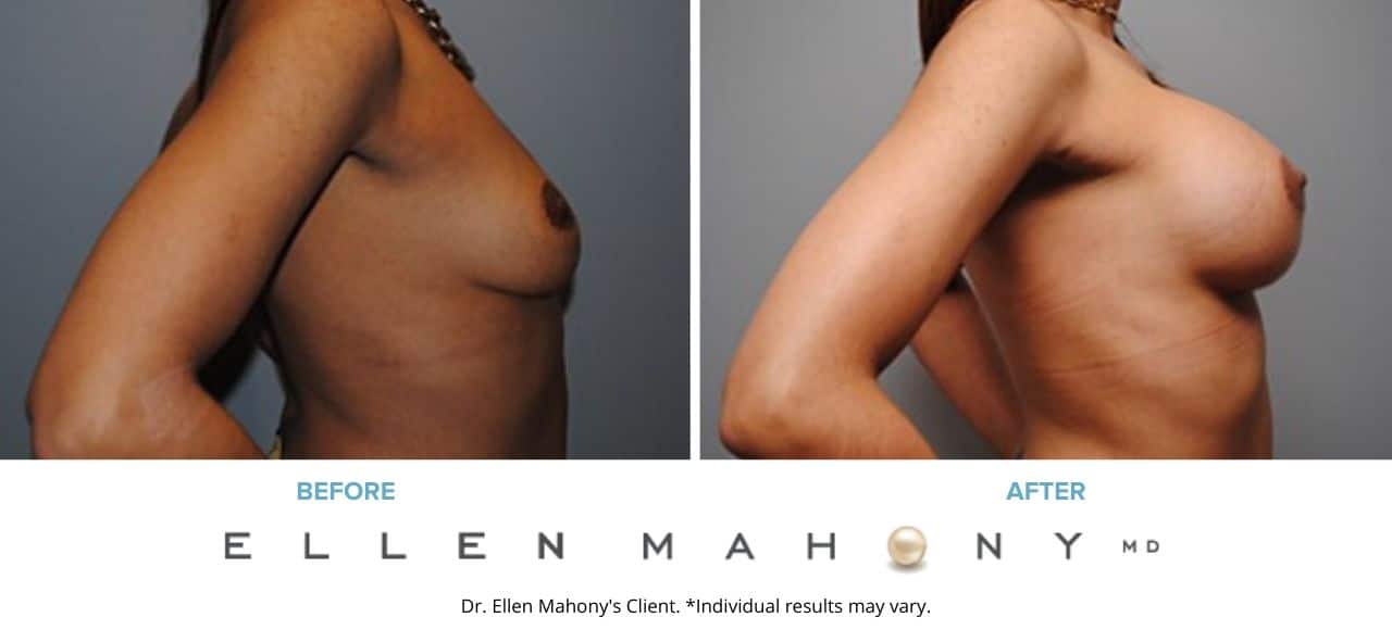 Breast Augmentation | Westport CT | Dr. Ellen Mahony