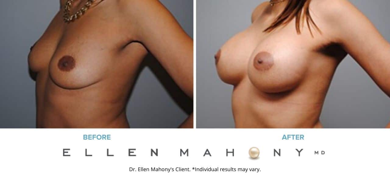 Breast Augmentation | Westport CT | Dr. Ellen Mahony