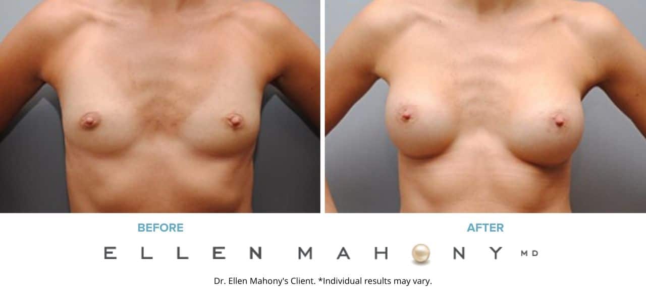 Breast Augmentation | Westport CT | Dr. Ellen Mahony