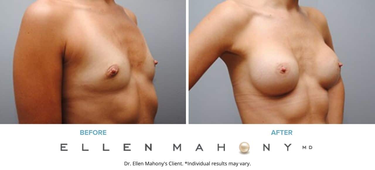 Breast Augmentation | Westport CT | Dr. Ellen Mahony