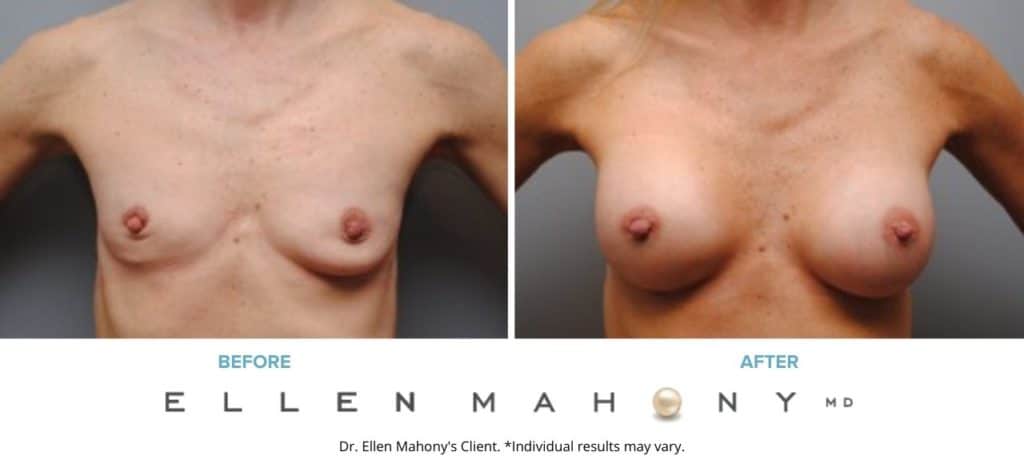 Breast Augmentation | Westport CT | Dr. Ellen Mahony