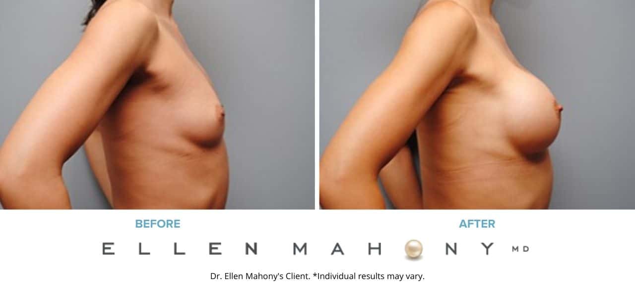 Breast Augmentation | Westport CT | Dr. Ellen Mahony