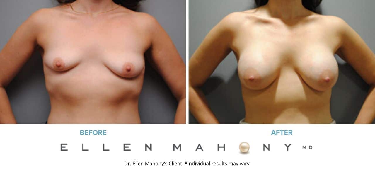 Breast Augmentation | Westport CT | Dr. Ellen Mahony