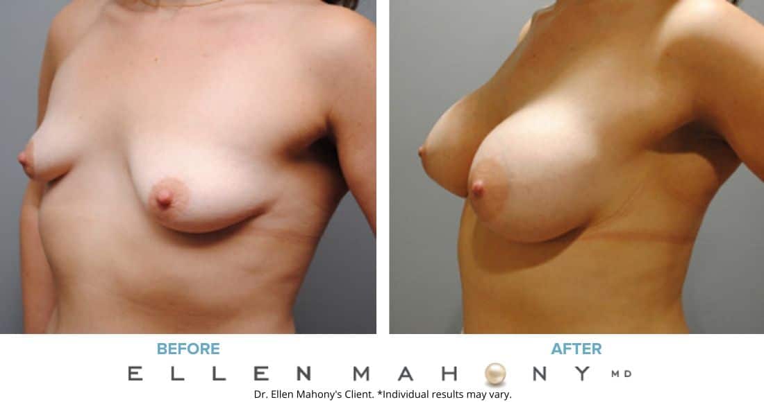 Breast Augmentation | Westport CT | Dr. Ellen Mahony