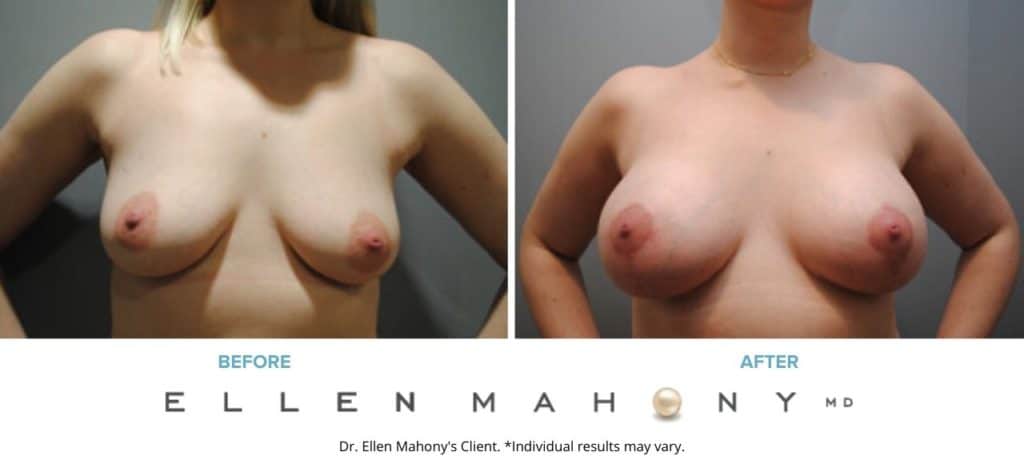 Breast Augmentation and Lift | Westport CT | Dr. Ellen Mahony