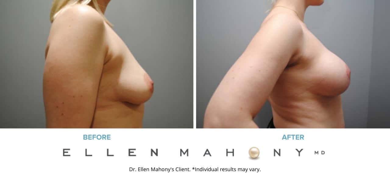 Breast Augmentation and Lift | Westport CT | Dr. Ellen Mahony