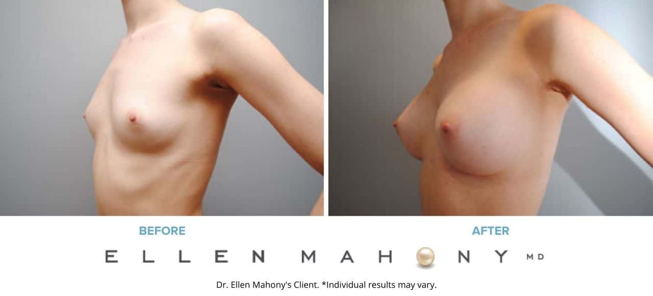 Breast Augmentation | Westport CT | Dr. Ellen Mahony