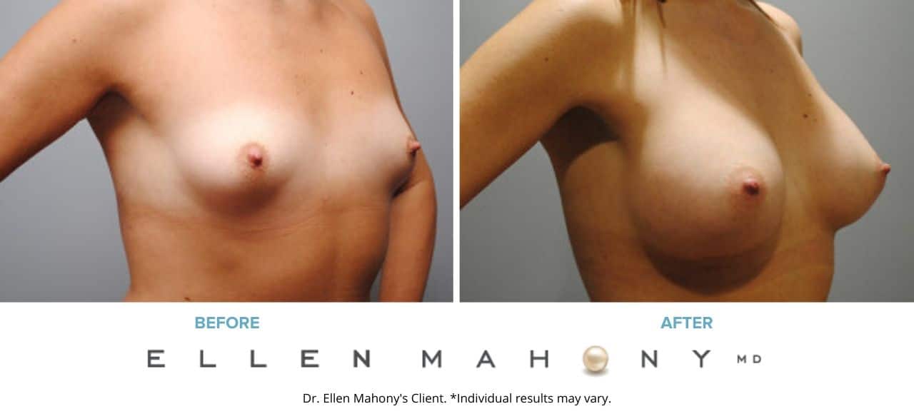 Breast Augmentation | Westport CT | Dr. Ellen Mahony