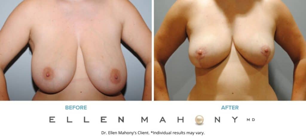 Breast Reduction | Westport CT | Dr. Ellen Mahony