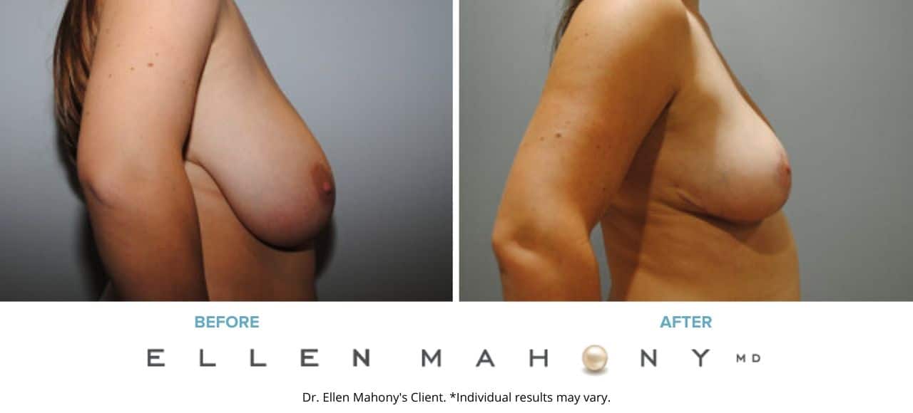 Breast Reduction | Westport CT | Dr. Ellen Mahony