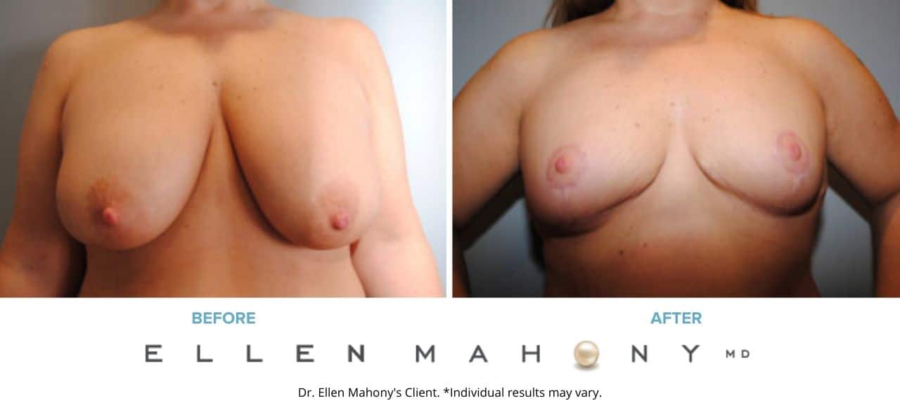 Breast Reduction | Westport CT | Dr. Ellen Mahony