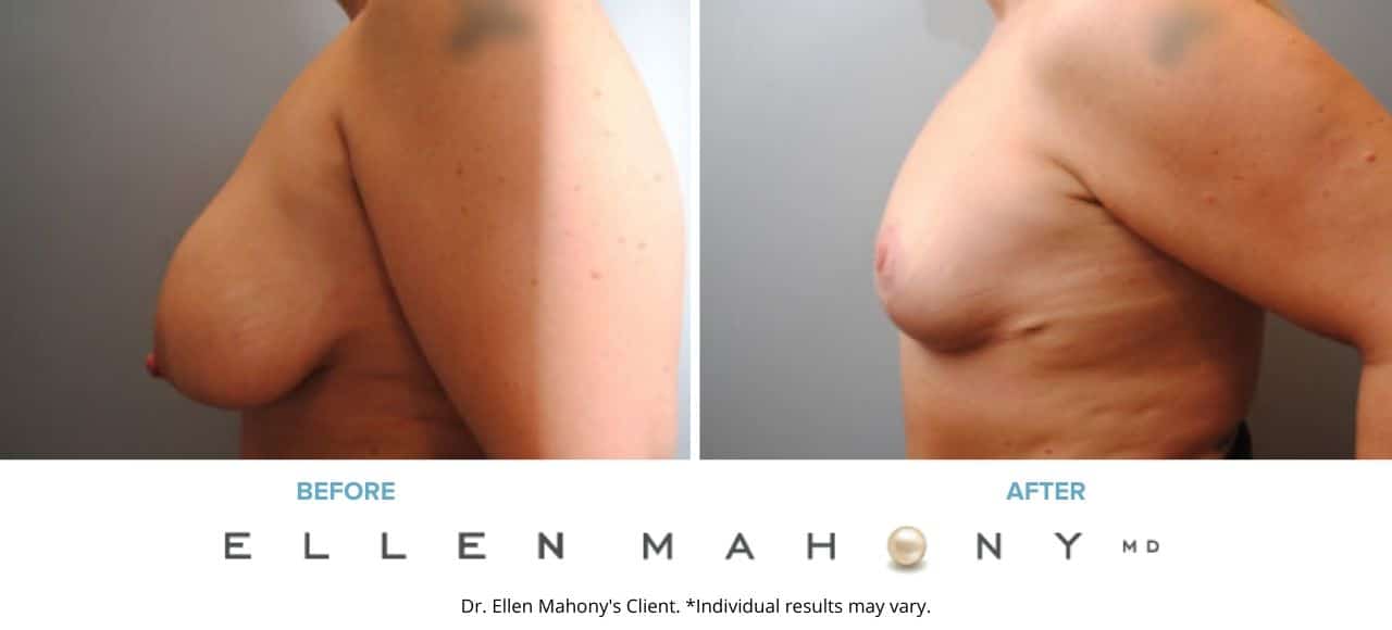 Breast Reduction | Westport CT | Dr. Ellen Mahony