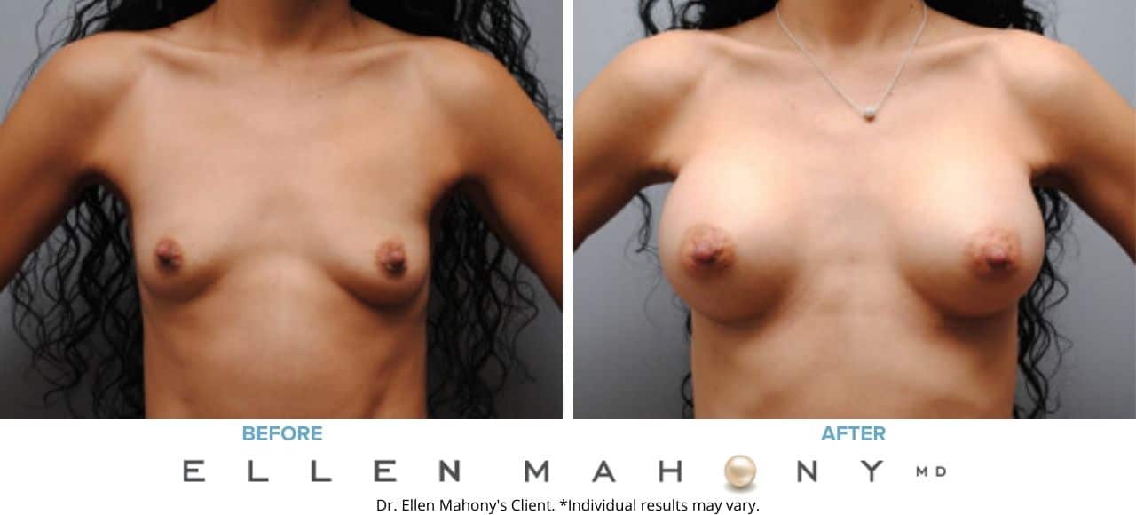 Breast Augmentation | Westport CT | Dr. Ellen Mahony