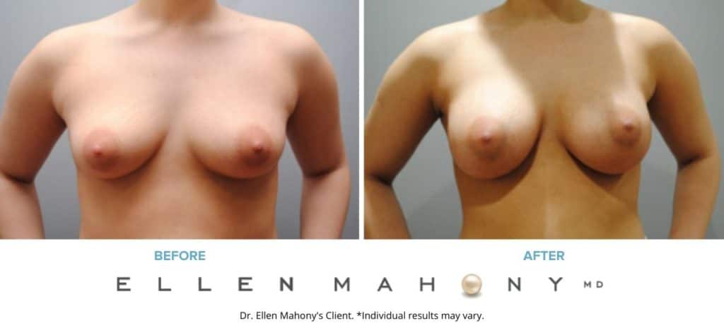 Breast Augmentation | Westport CT | Dr. Ellen Mahony