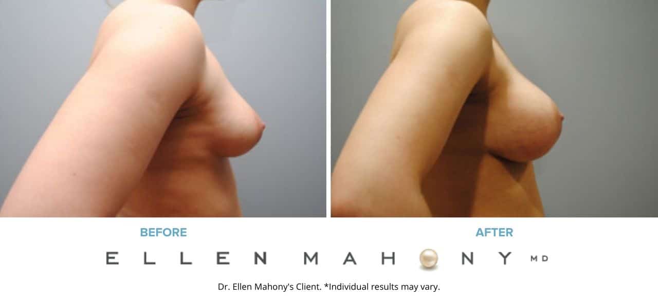 Breast Augmentation | Westport CT | Dr. Ellen Mahony