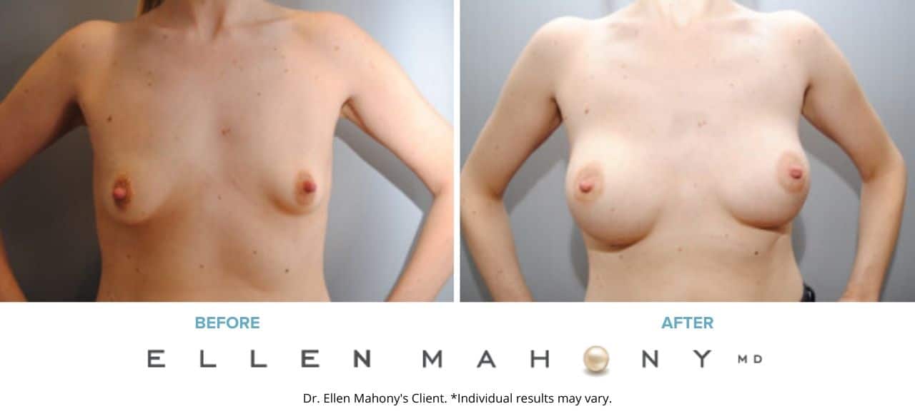Breast Augmentation | Westport CT | Dr. Ellen Mahony