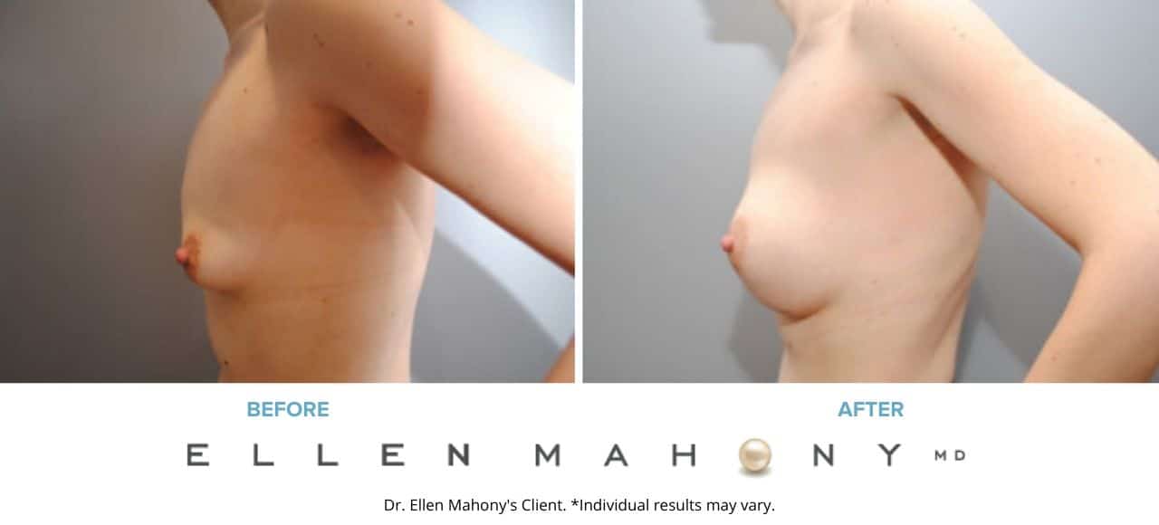 Breast Augmentation | Westport CT | Dr. Ellen Mahony