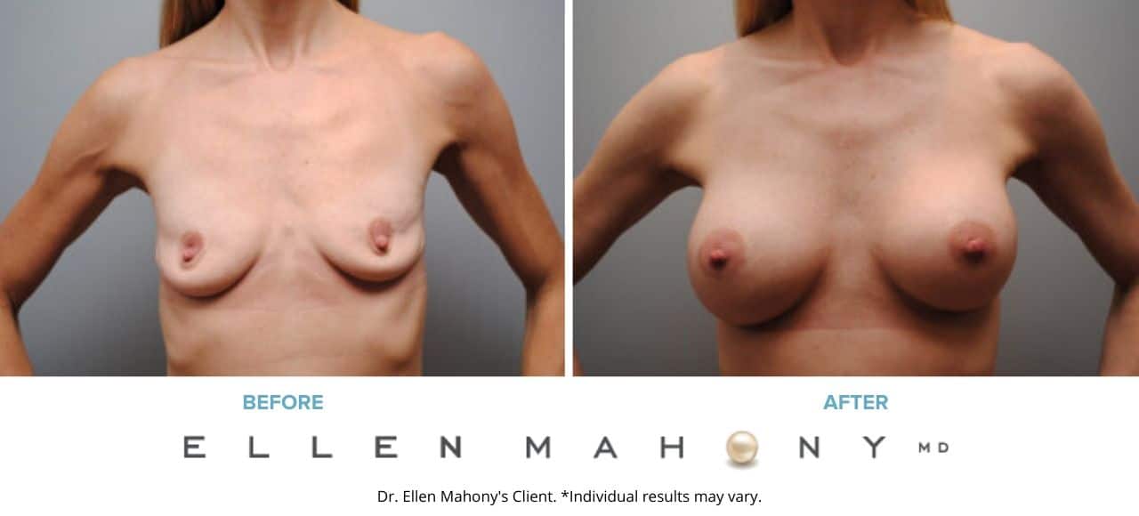 Breast Augmentation | Westport CT | Dr. Ellen Mahony