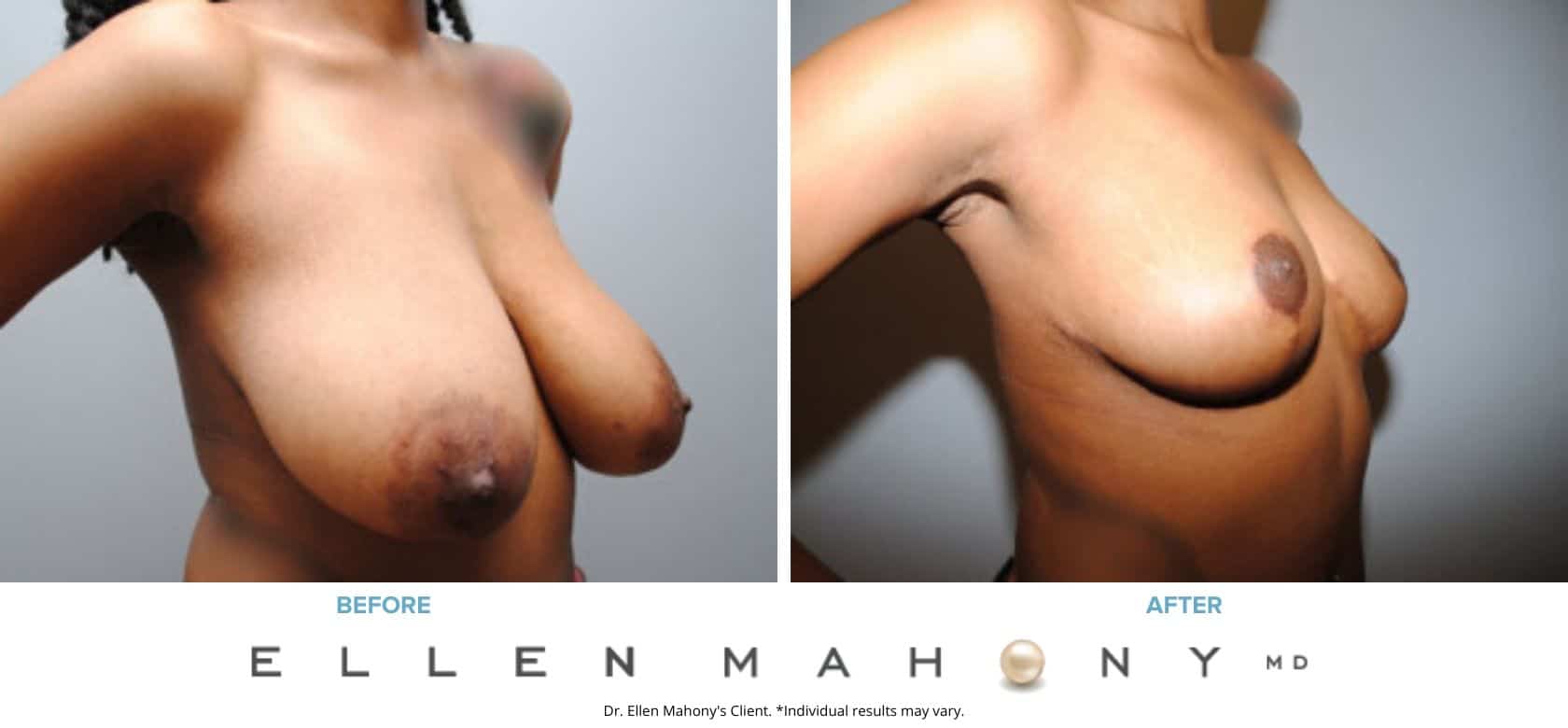 Breast Reduction | Westport CT | Dr. Ellen Mahony