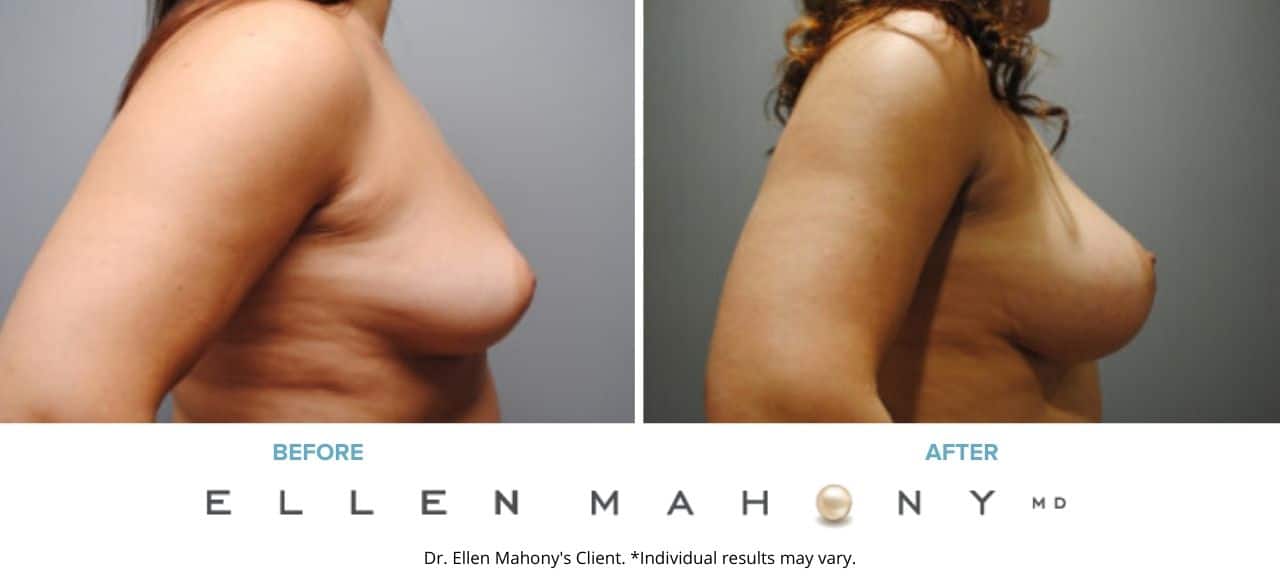 Breast Augmentation | Westport CT | Dr. Ellen Mahony