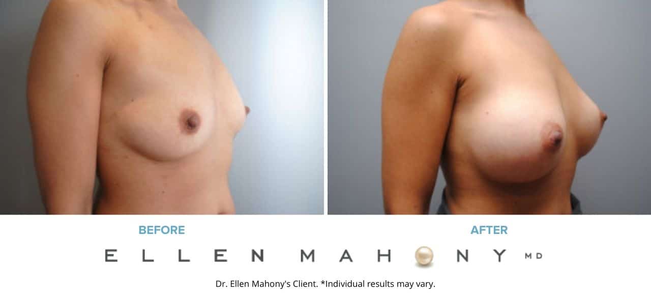 Breast Augmentation | Westport CT | Dr. Ellen Mahony