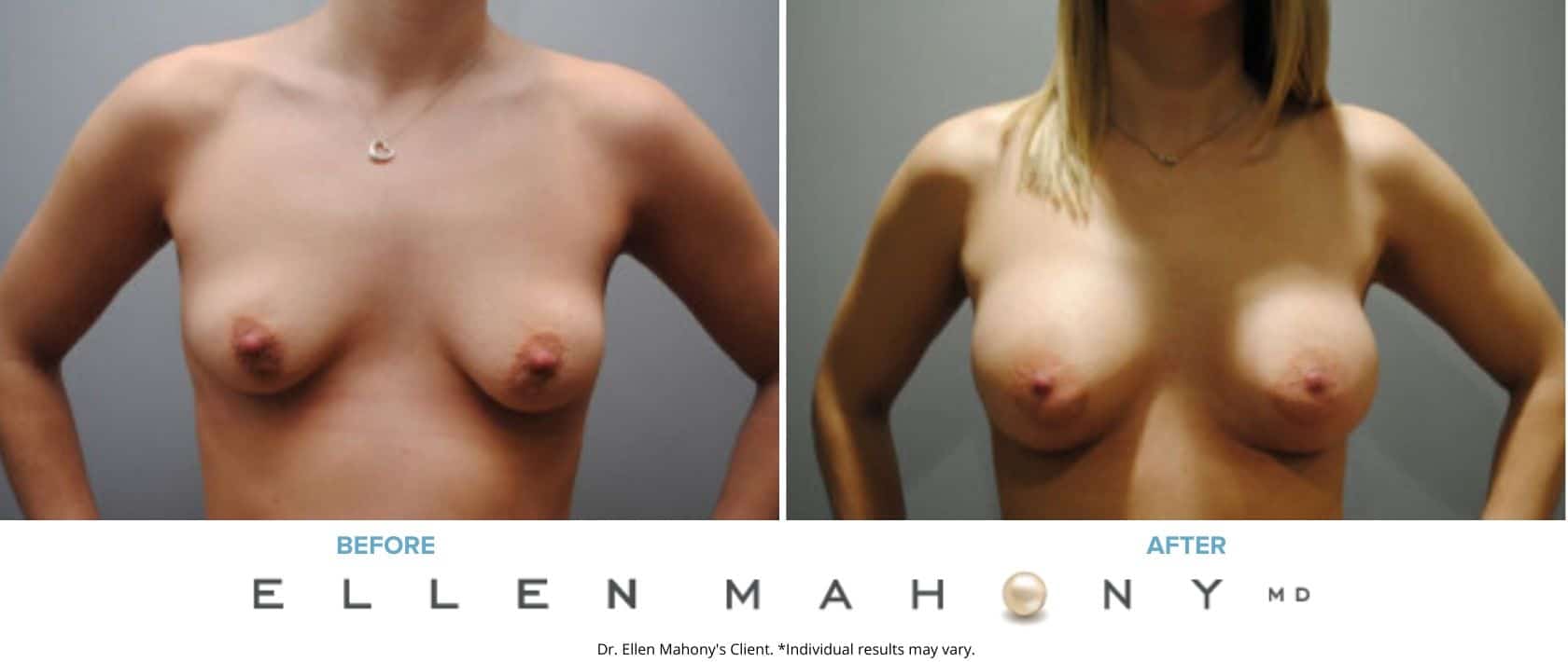 Corrective Breast Surgery | Westport CT | Dr. Ellen Mahony