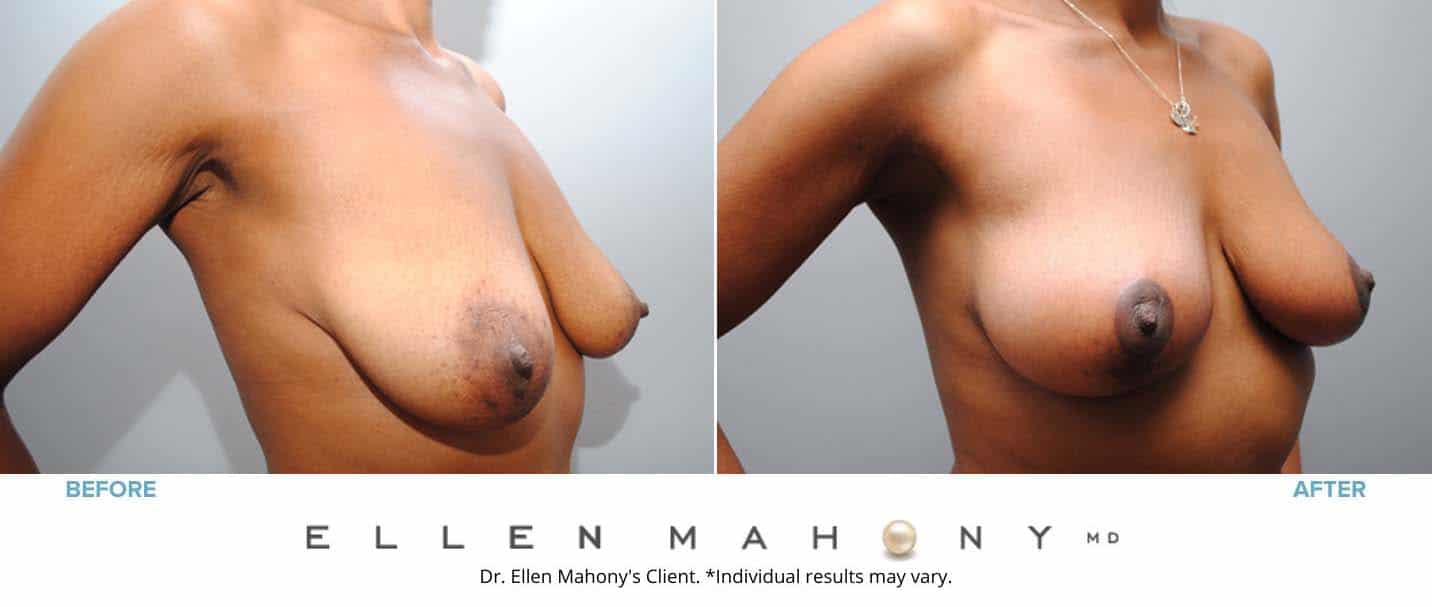Breast Reduction | Westport CT | Dr. Ellen Mahony