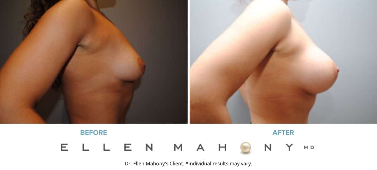 Breast Augmentation | Westport CT | Dr. Ellen Mahony