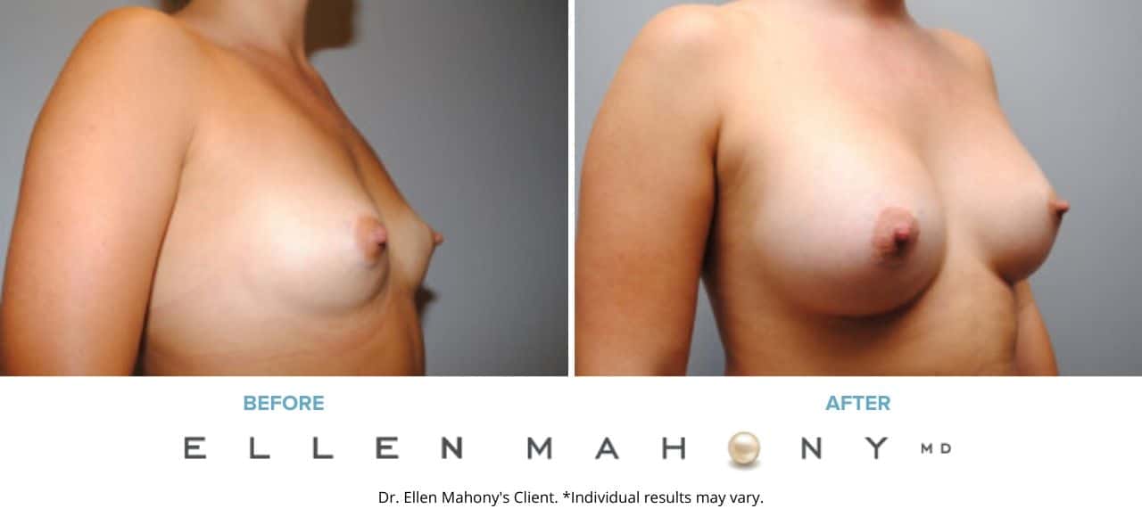 Breast Augmentation | Westport CT | Dr. Ellen Mahony